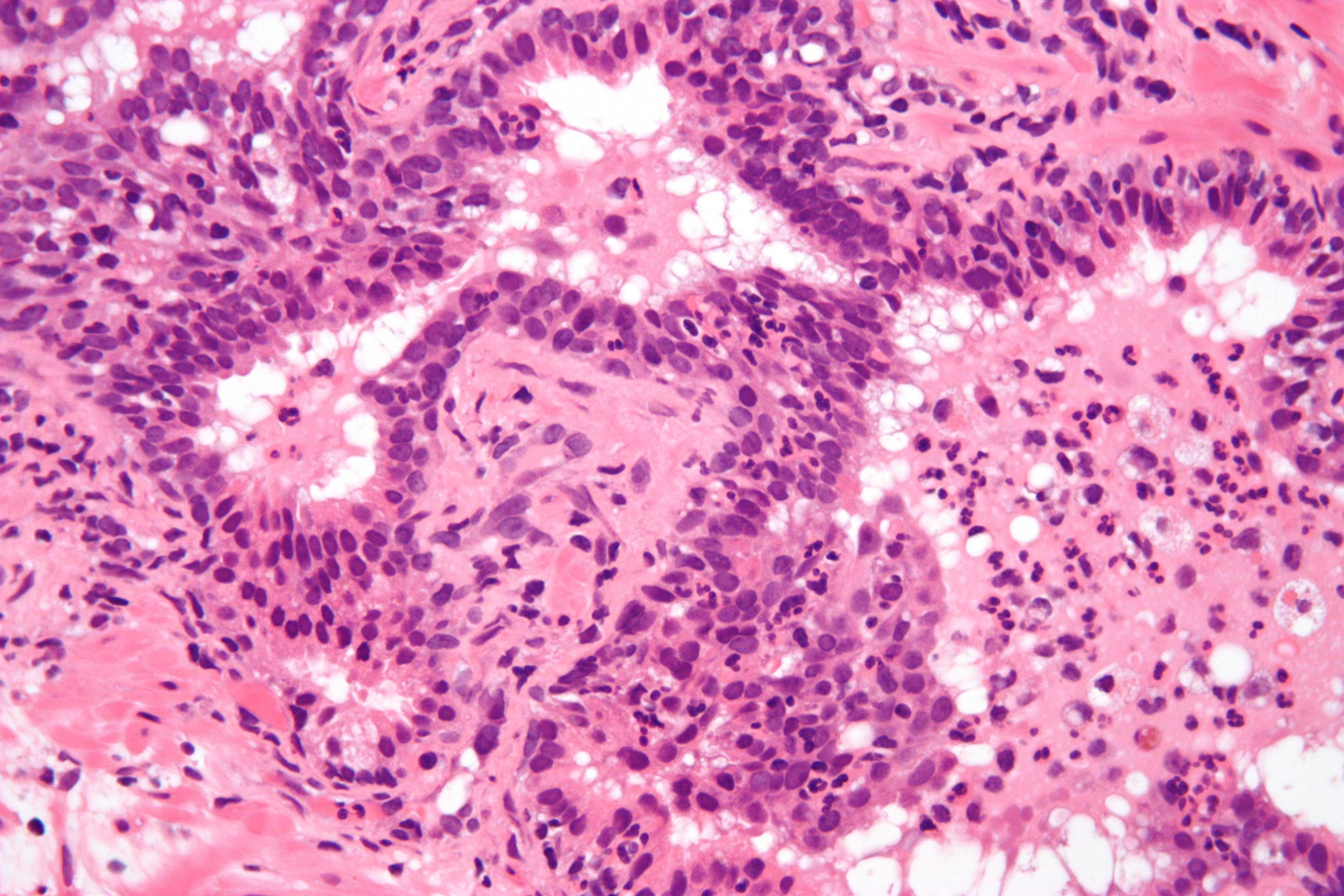 acute_inflammation_of_prostate